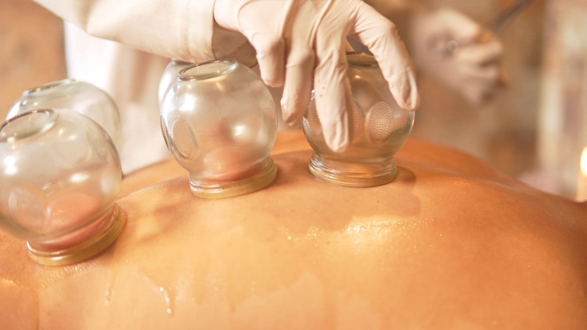 Glass cups placed during a cupping therapy session